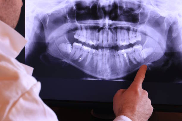 Best Emergency Root Canal Treatment in Sebewaing, MI